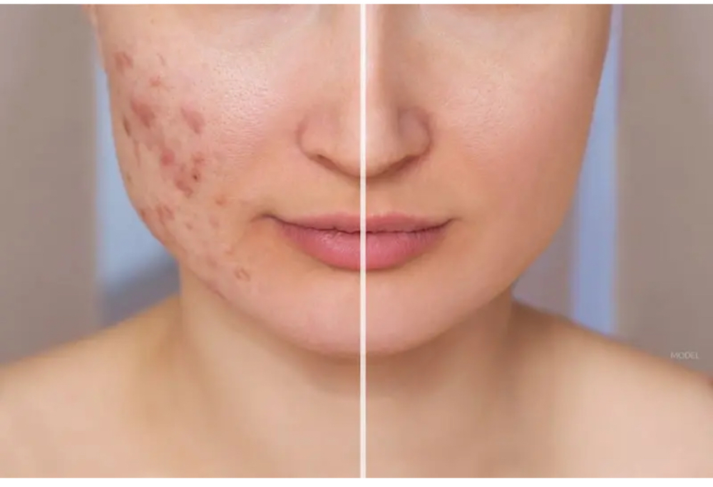 Acne Scar Treatments Per Session