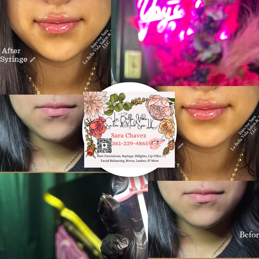 Lip Filler 1/2 Syringe