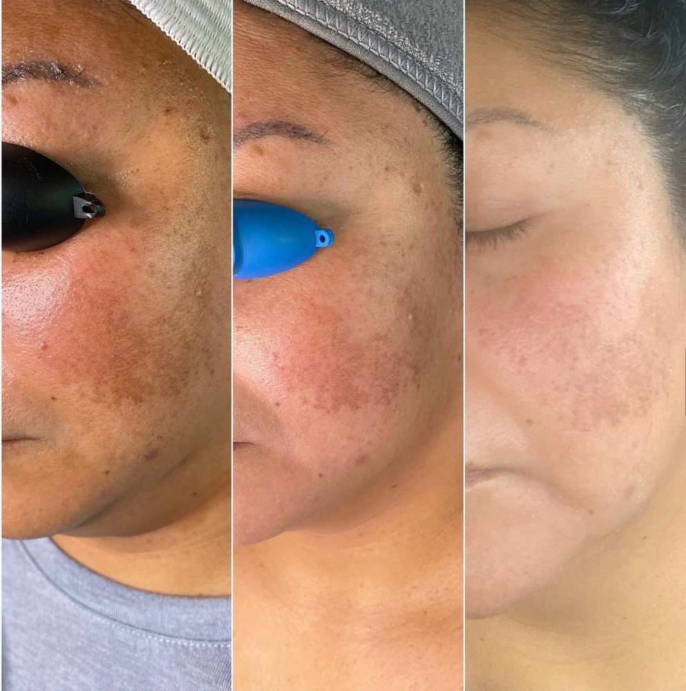 Brightening Peel