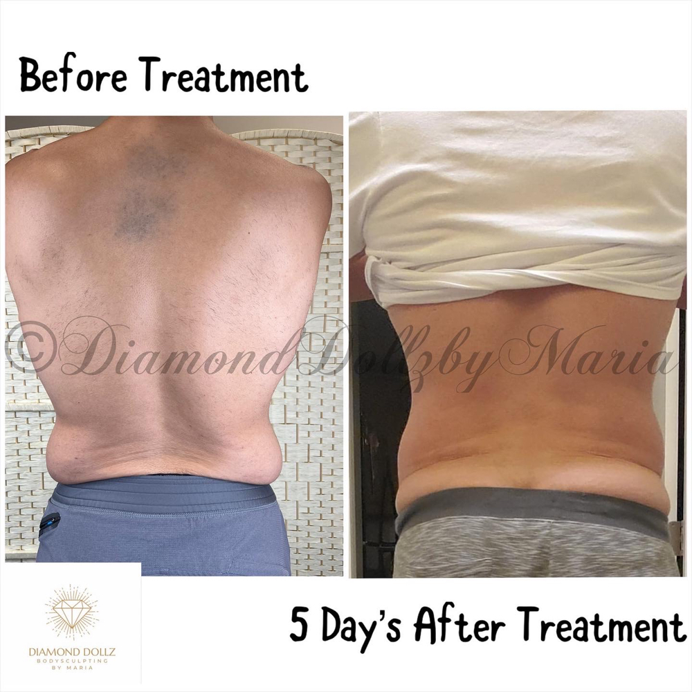 (For Men) Tighten & Tone ( Back)
