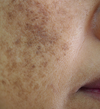 Melasma Clear Complex 🧪