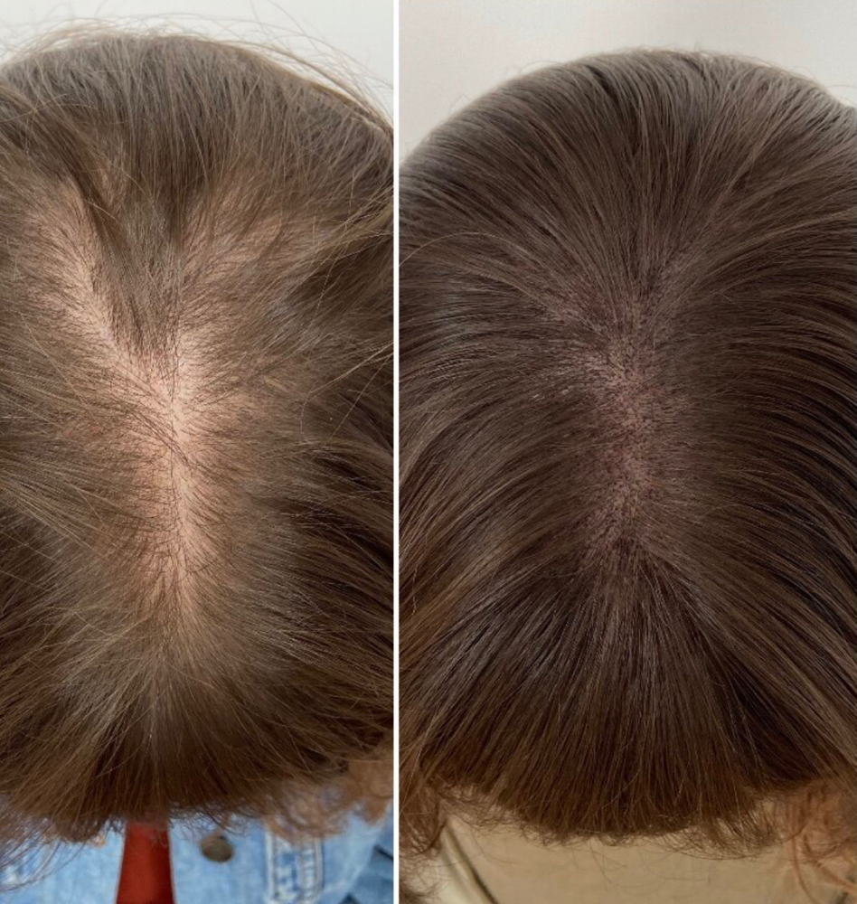 Scalp Micropigmentation