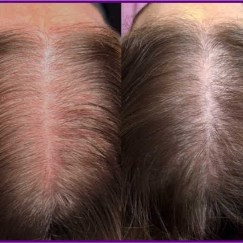 ProCell Hair Restoration at Betty Brill Esthetics in Sarasota, FL