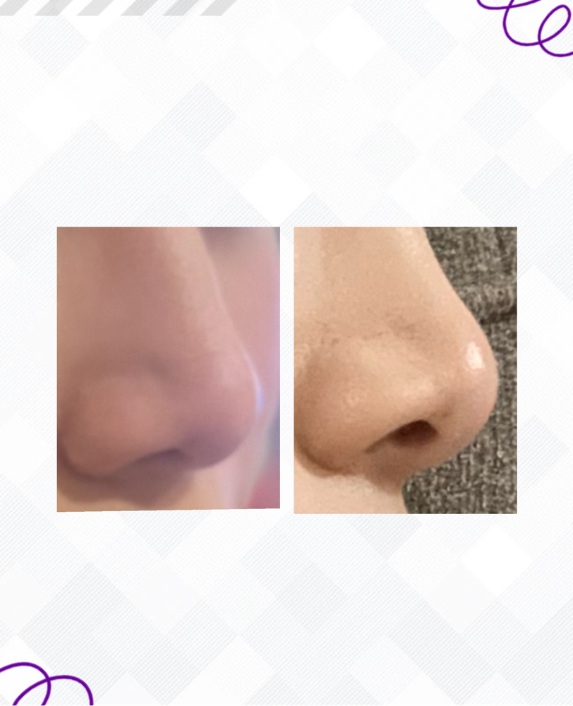 Nasal Botox Treatment at Glam X Sam MedBeauty in Andrews, TX