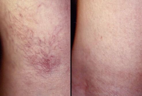 Sclerotherapy