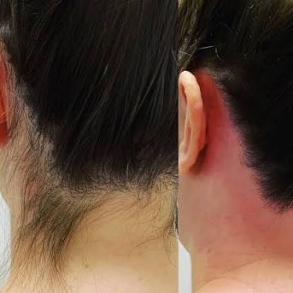 Renew+Define • Neckline Wax at The UnSpa | Skin Renewal Studio in Chandler, AZ
