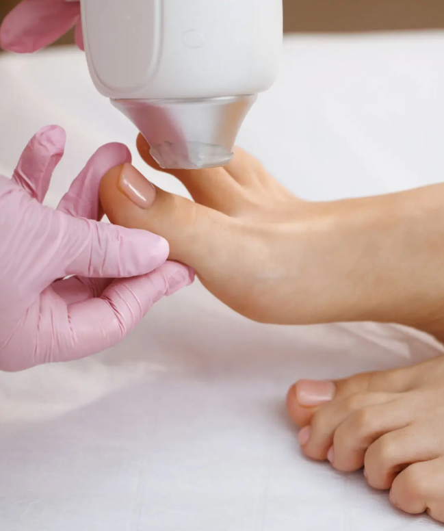 Laser Fungus Treatment