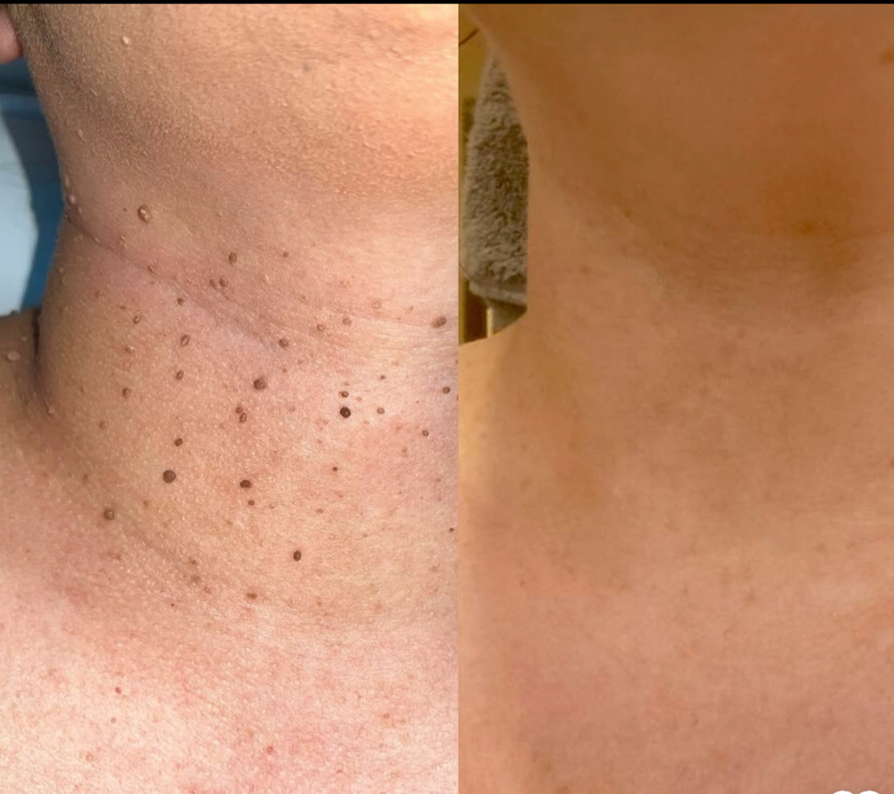 Consult/ Skin Imperfection Removal