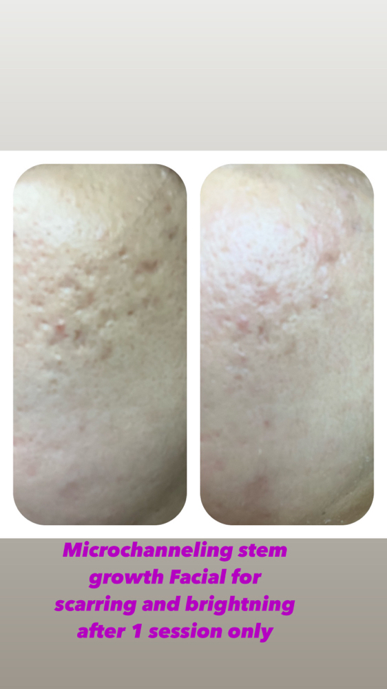 Microchanneling Facial (Stem Cell)