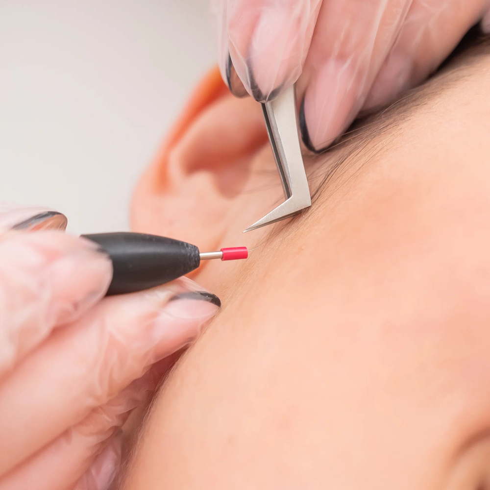 Electrolysis Consultation
