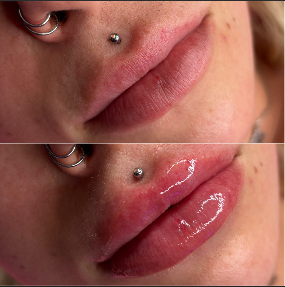 1.5ML Lip Filler