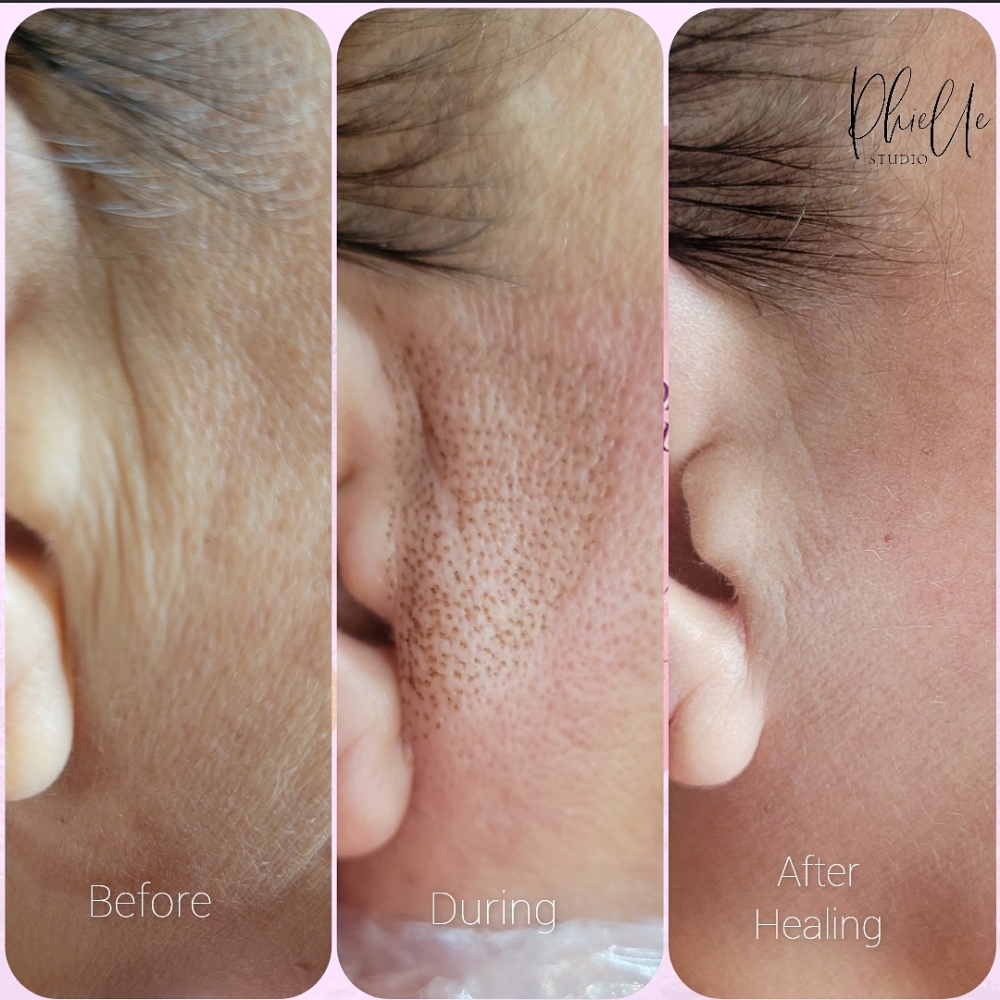 Fibroblast Lift Sideburns