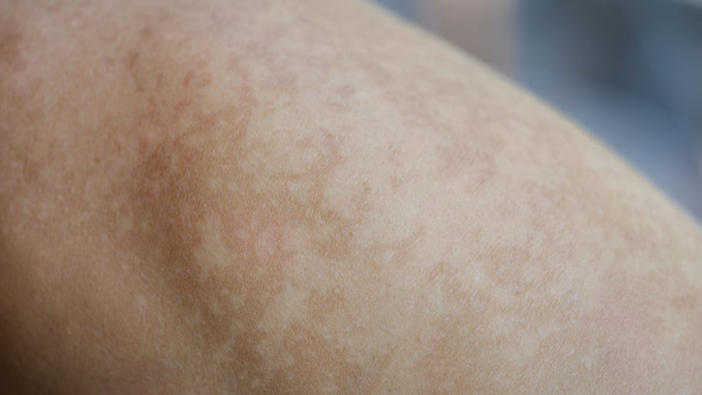 Hypopigmentation Restoration