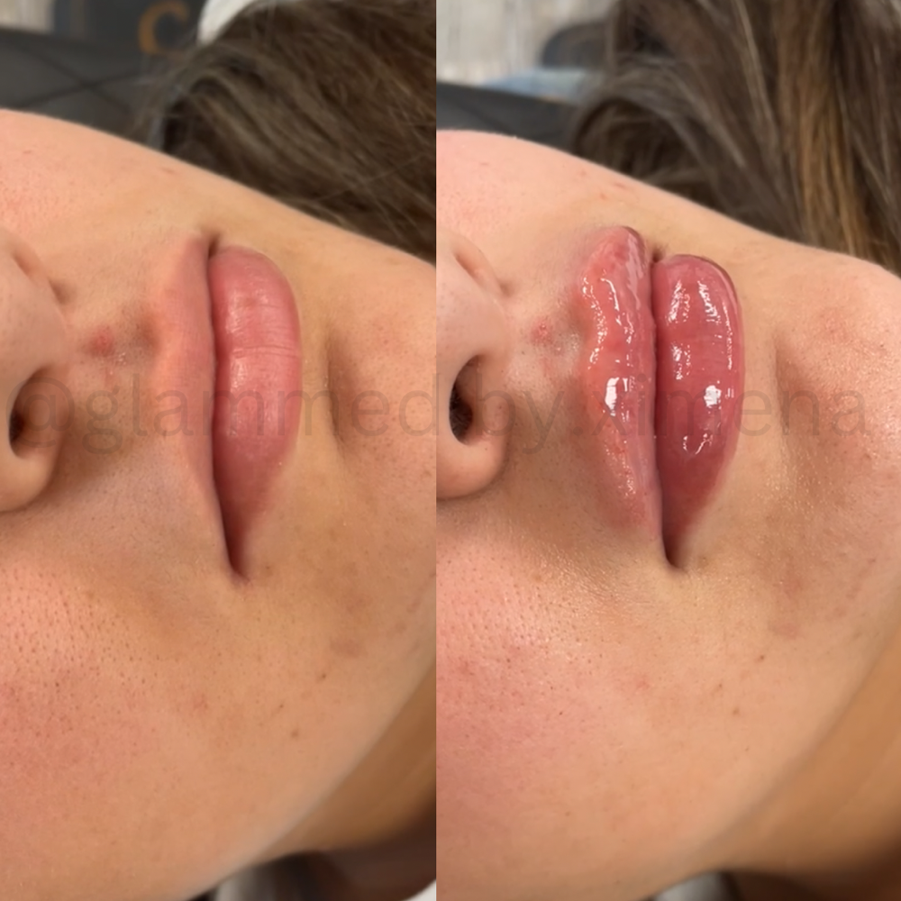 Hyapen Lip Filler -1mL