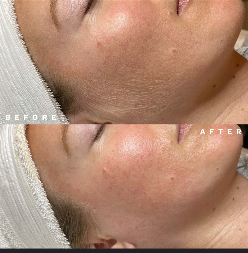 DC DermaPlaning