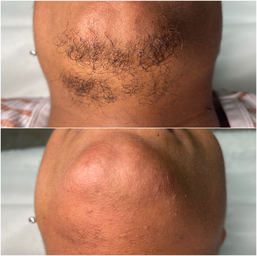 Chin and Lower Lip