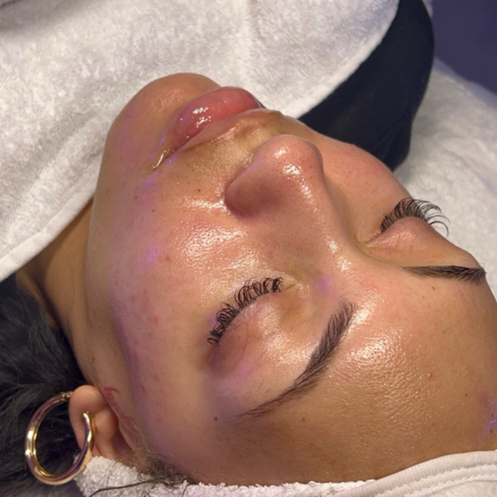 Diamond Peel (No Peeling) at Beauty Therapy by Chanel in Tucker, GA