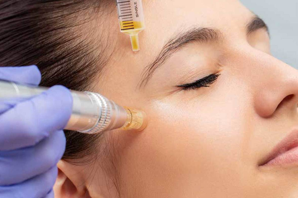 PRP (Platelet Rich Plasma) Injected