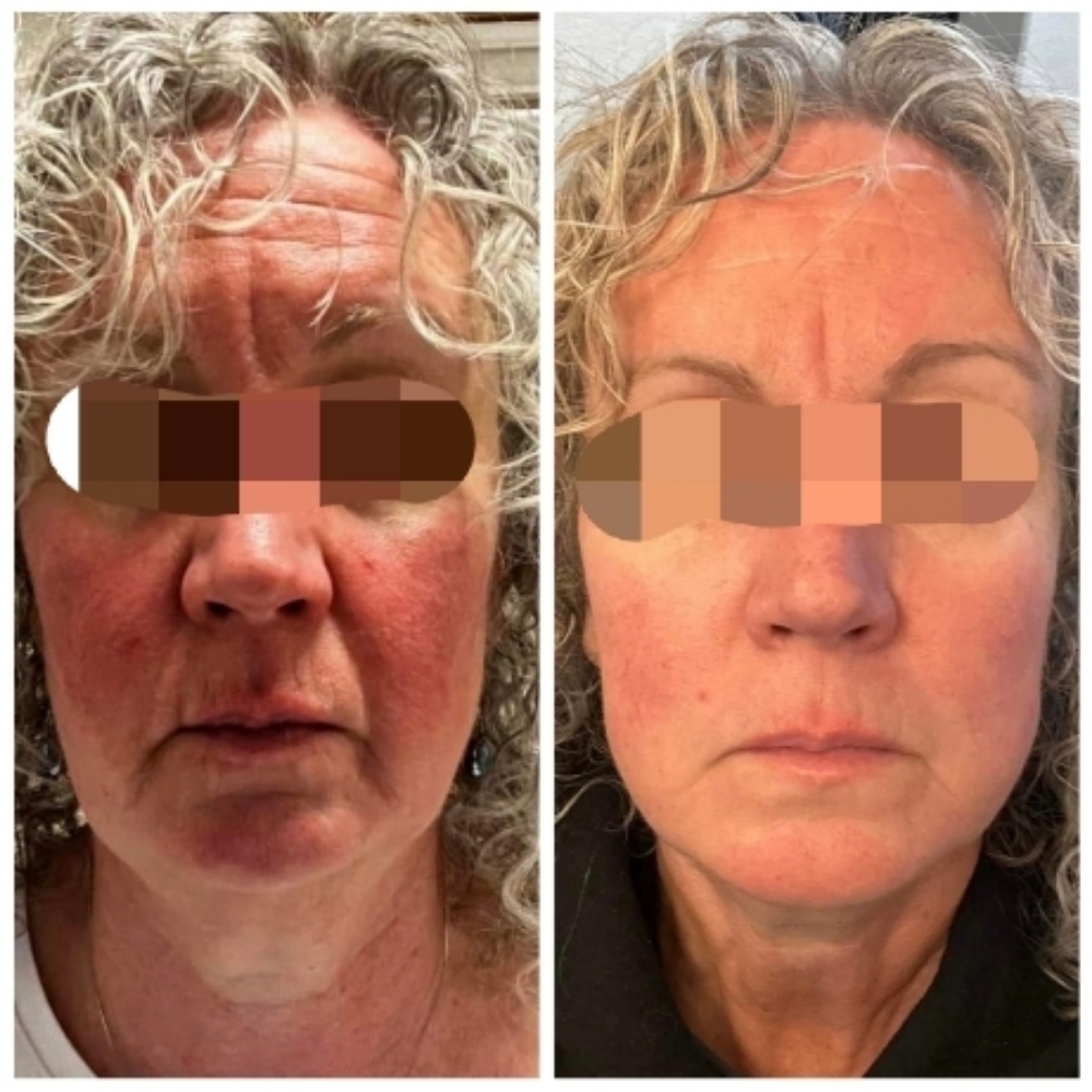Sensitive Skin Treatment at Sun Skincare LLC in Scottsdale, AZ