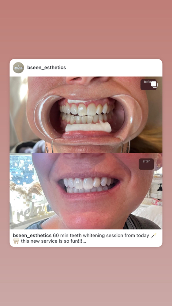 80 Min Teeth Whitening Session