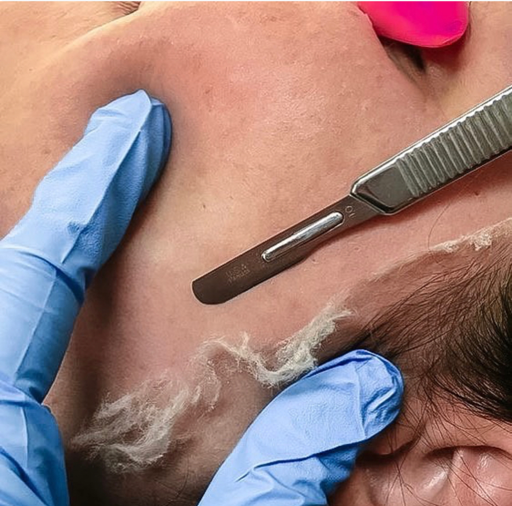 Dermaplaning Facial