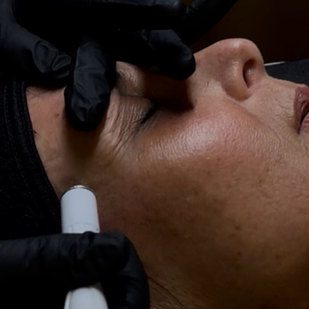 Microdermabrasion Facial at Ashlyn Rogers Esthetics in Paducah, KY