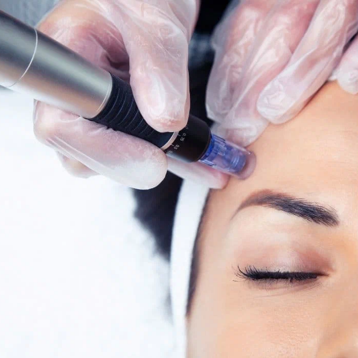 Microneedling Treatment at Stony Point Spa in Watertown, SD