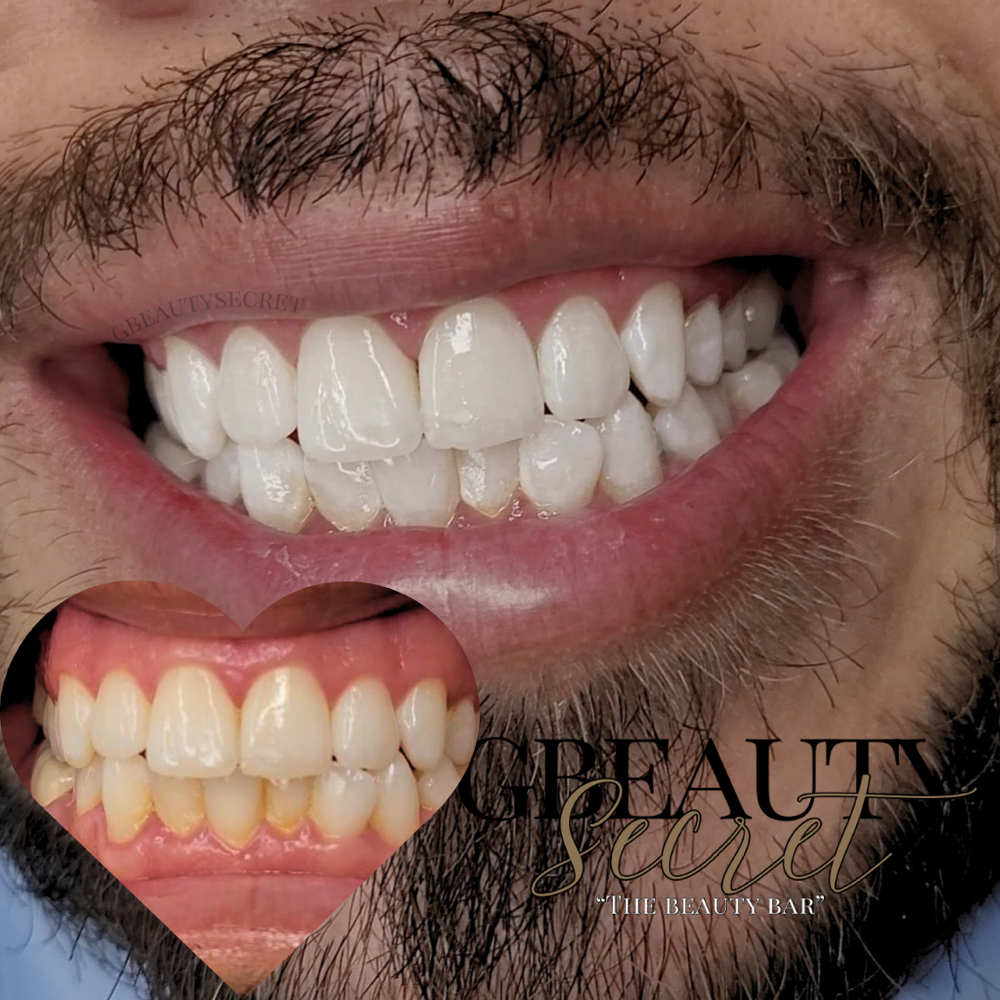 Teeth Whitening: 60 Mins
