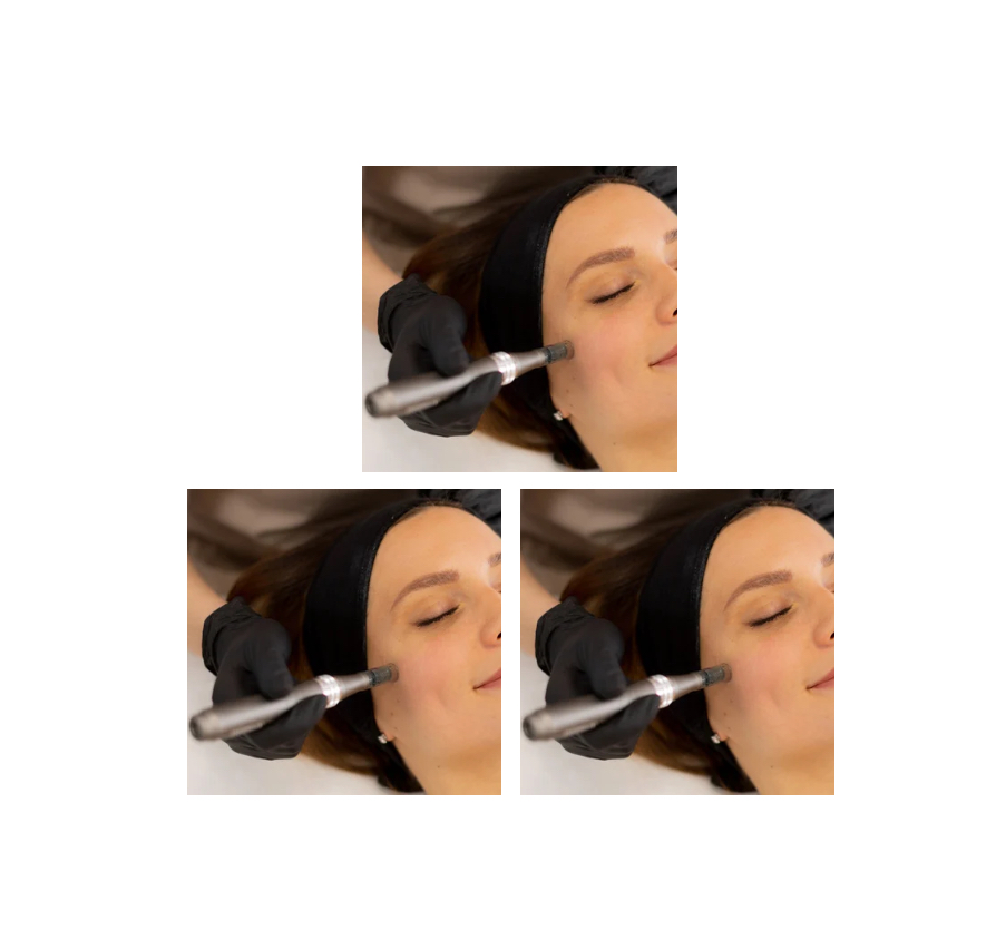 Microneedling Package