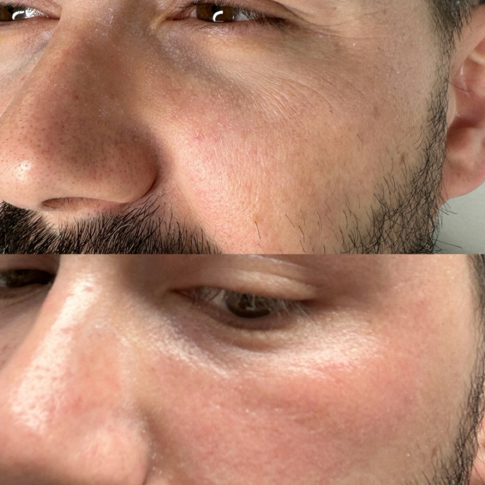 Lower eyelift at Magnolia Plasma Fibroblasting By Mitra in Frisco, TX