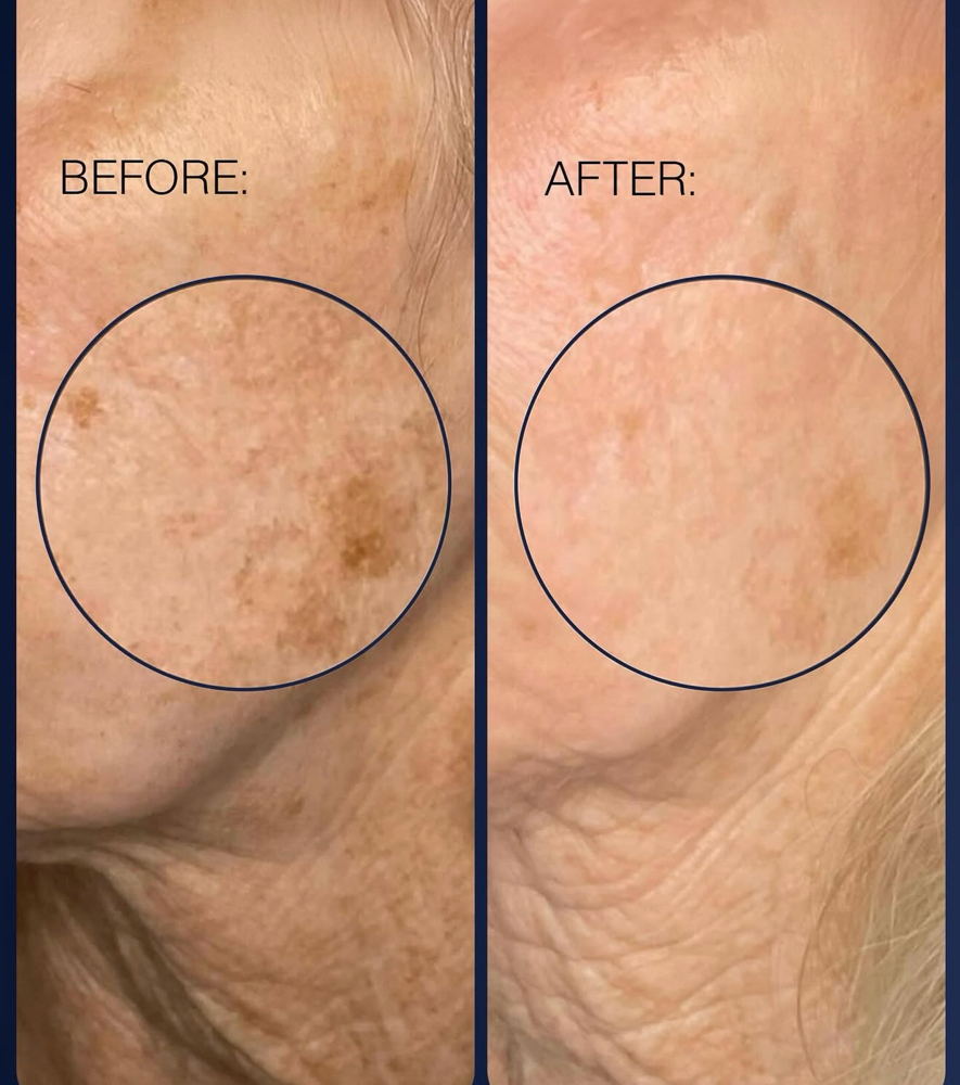 PCA Peels at Skin & Body by Milly in Casselberry, FL