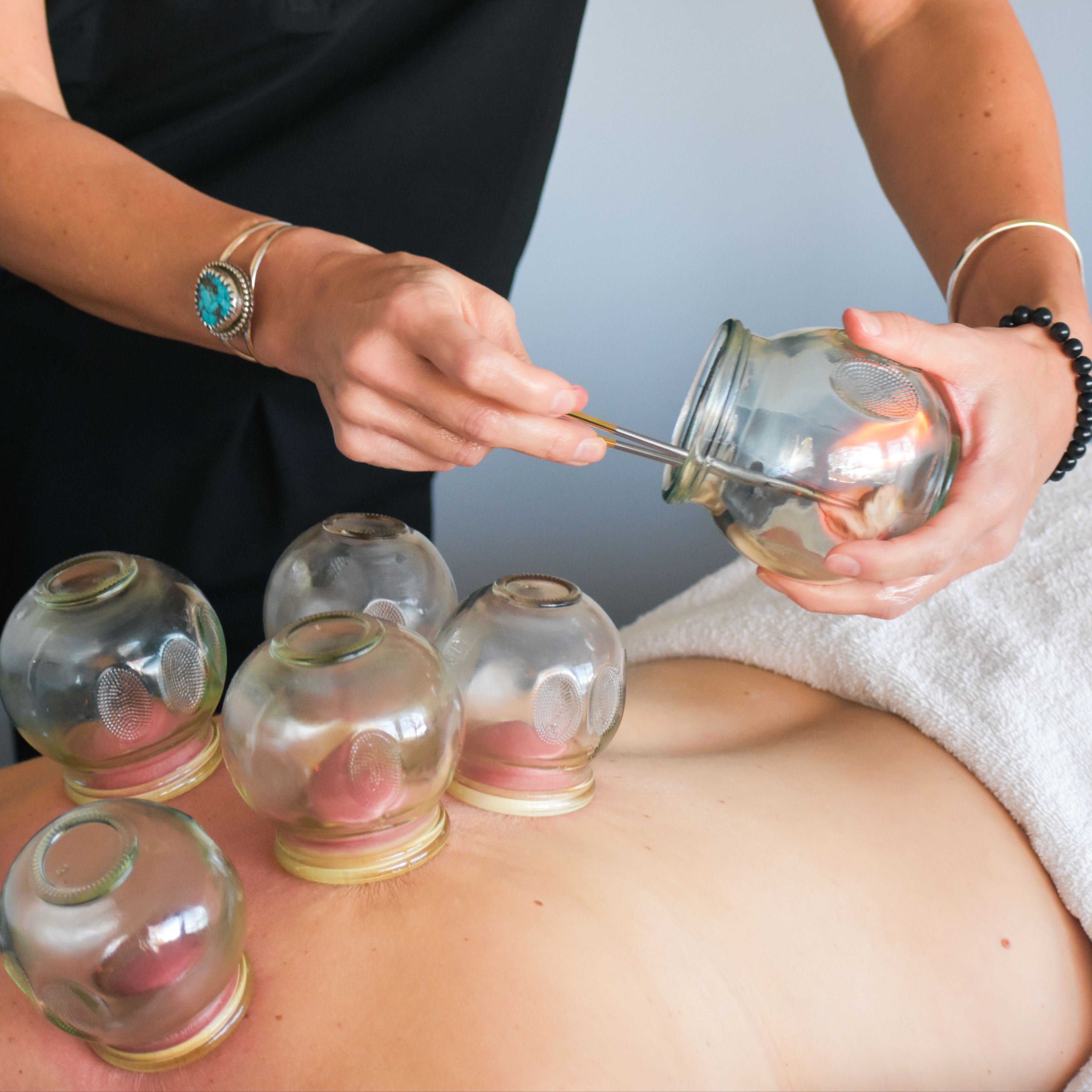 New Patient Fire Cupping Therapy