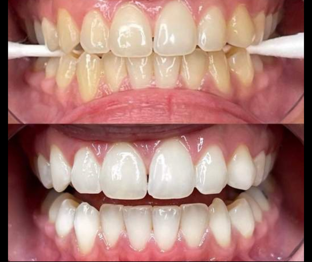 Teeth Whitening