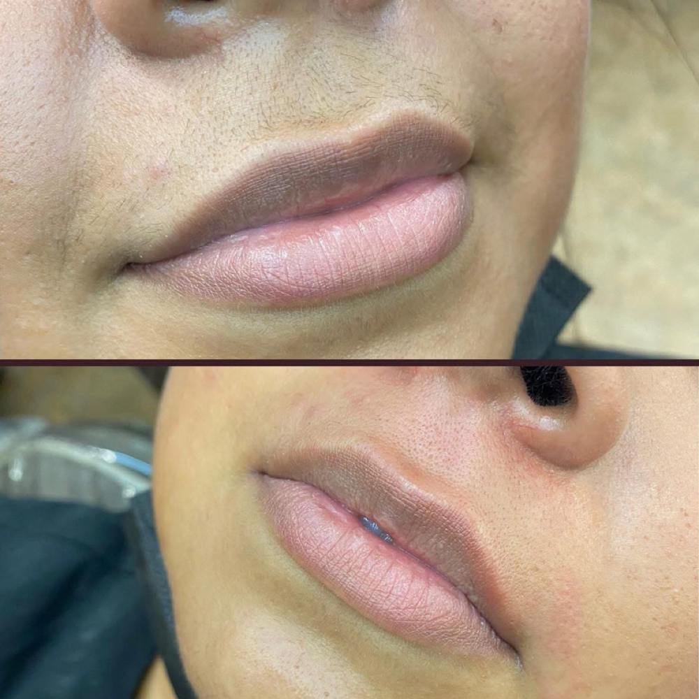 Upper Lip at The Aesthetix Lounge in San Clemente, CA