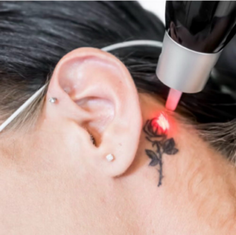Tattoo Removal SM - Unlimited at NICHÉ in Lewisville, TX