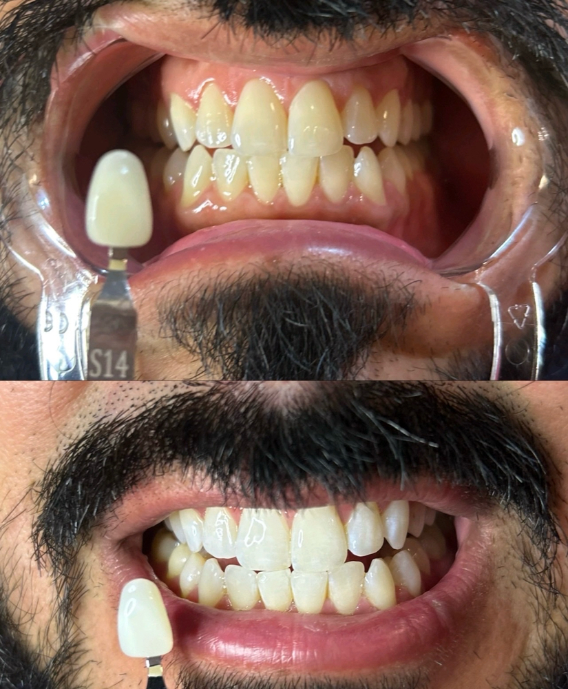 1 Hour Teeth Whitening