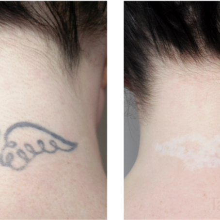 TATTOO REMOVAL