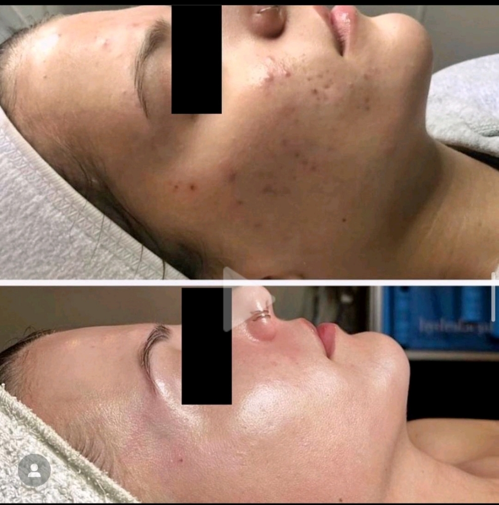 Customized Facial