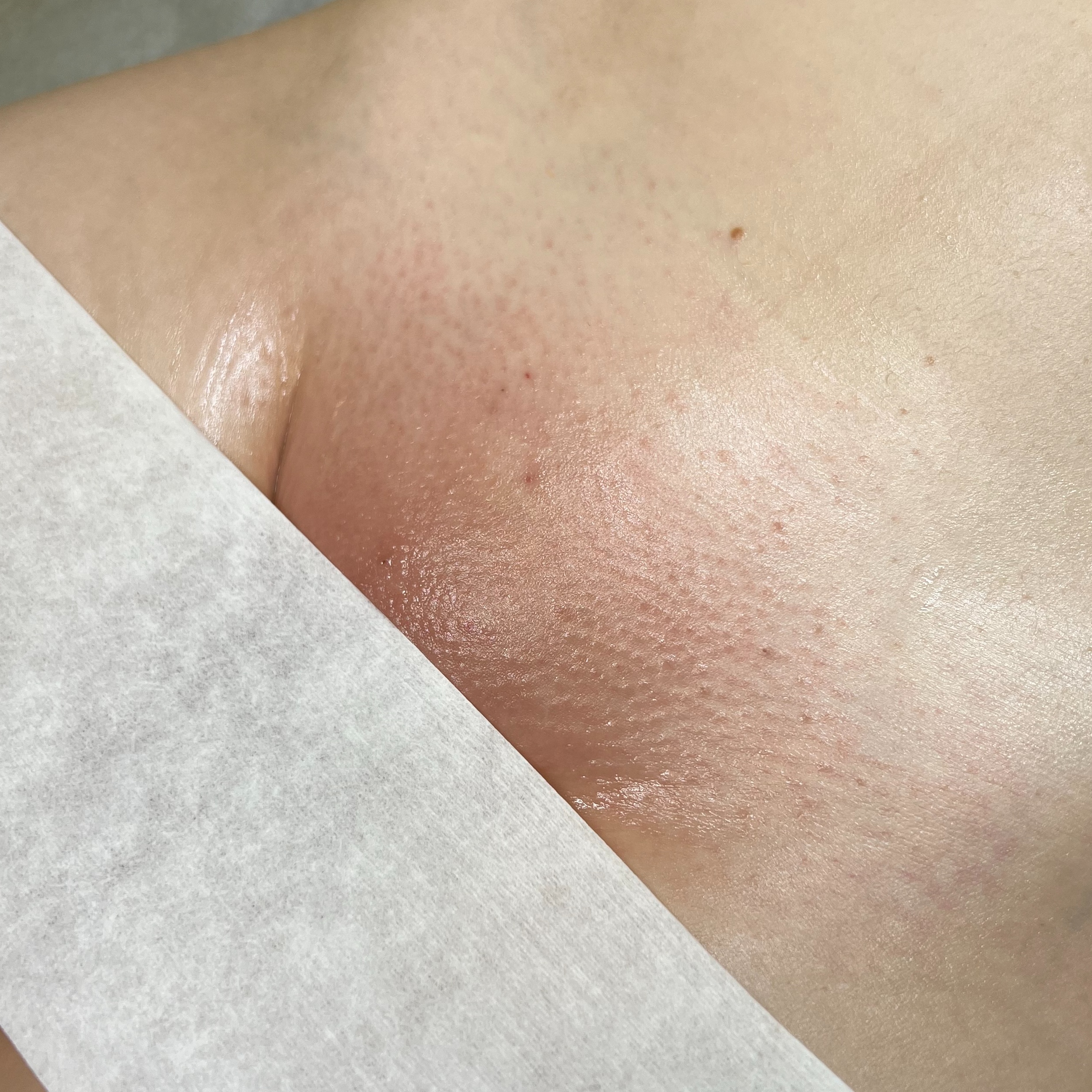 Extended Brazilian Wax at Aureate Aesthetics in Dallas, TX