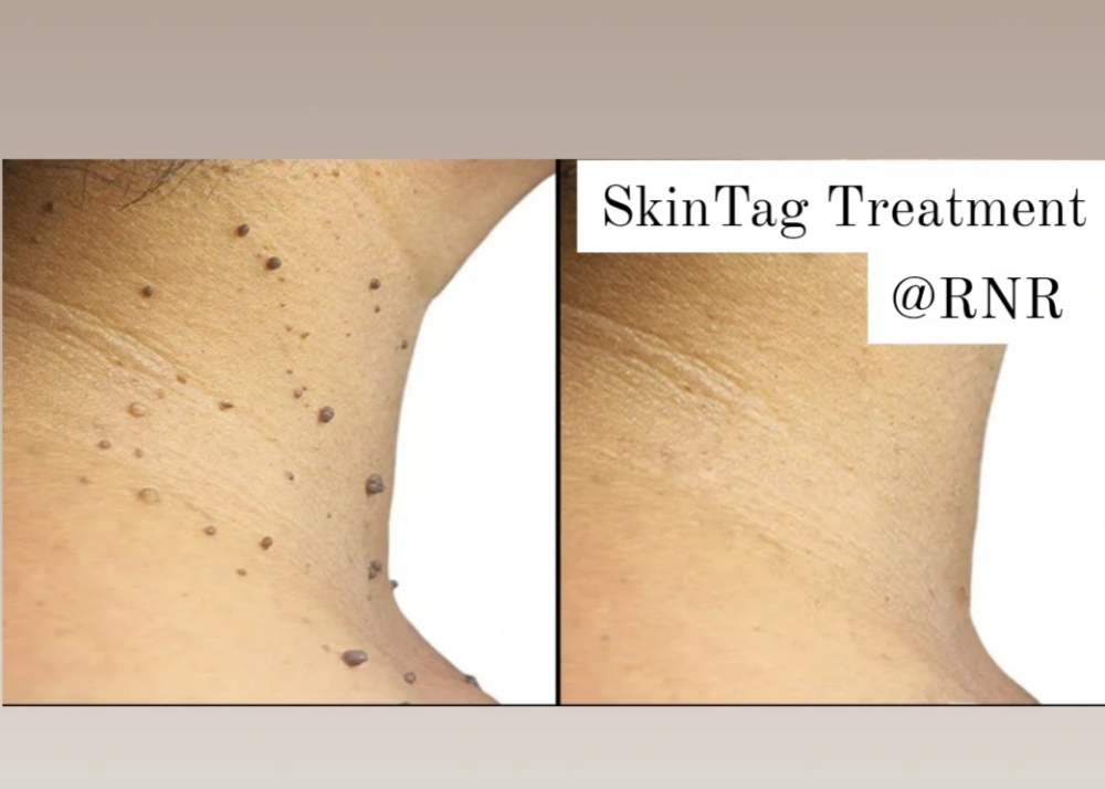 SkinTag Treatment