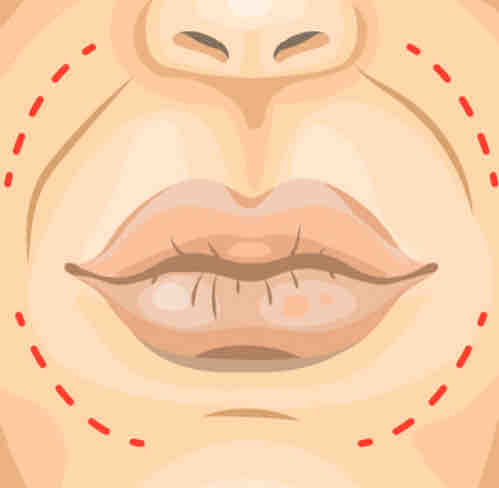 Smile Lines at Alchemy Med Spa in Houston, TX