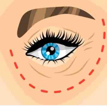 Under Eye THREADS at Alchemy Med Spa in Houston, TX