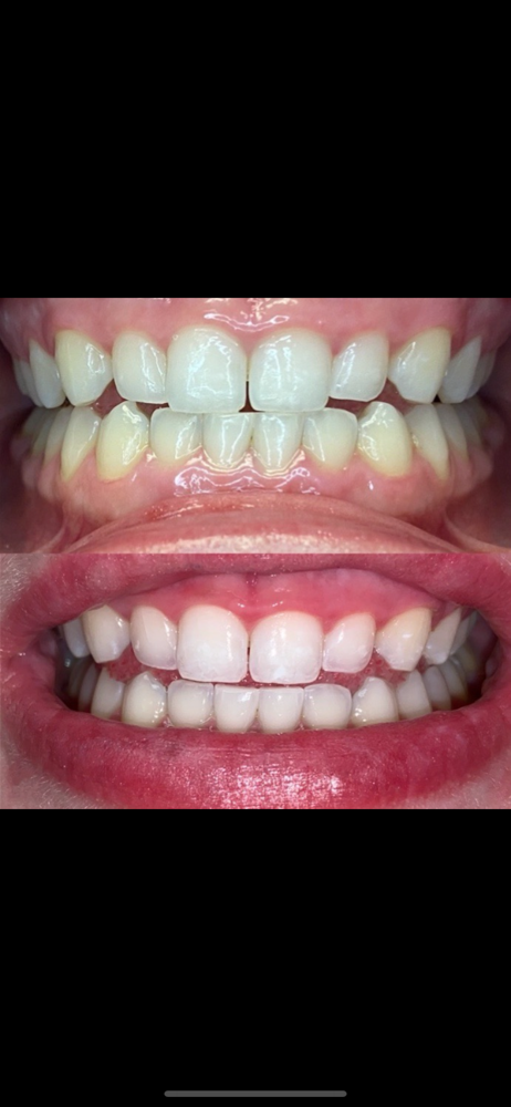 Professional Teeth Whitening