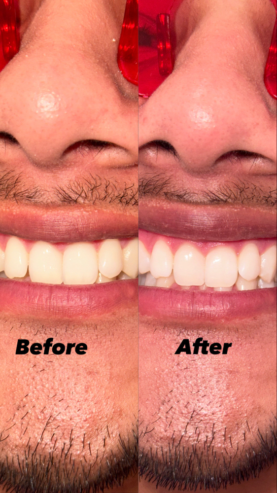 60 Min Teeth Whitening