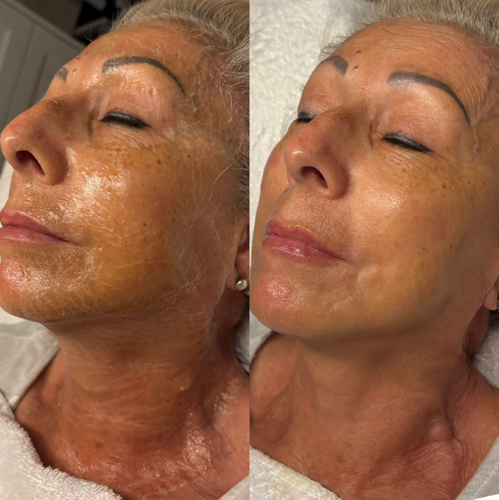 No Tox “Botox” Facial at Linda Piel in San Antonio, TX