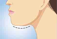 Kybella at Alchemy Med Spa in Houston, TX