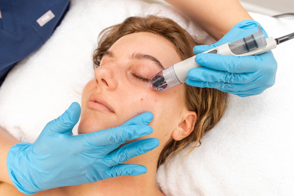 Microneedling & Microdermabrasion at Jordyn Sprague, Esthetician in Roscommon, MI