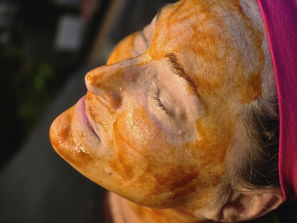 Vitamin Infusion + Micro-channeling at Amie Hawks Esthetics in Raleigh, NC