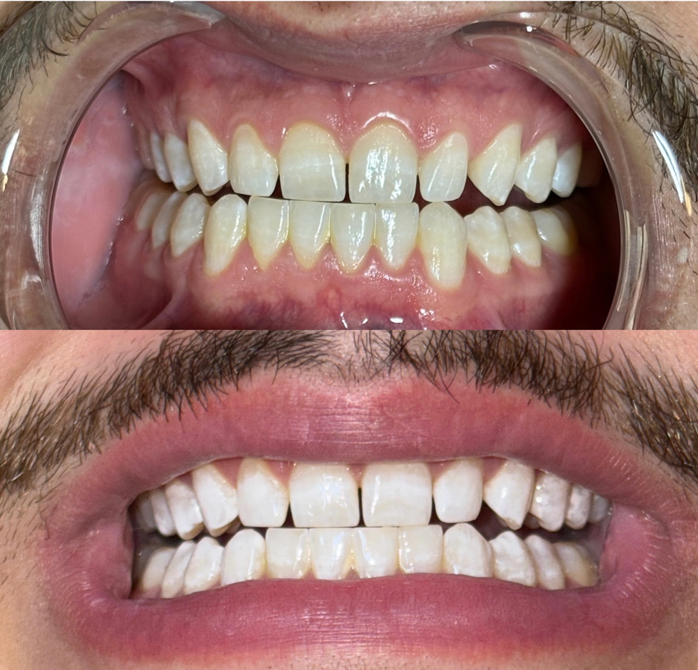 Teeth Whiteing 95 Min.