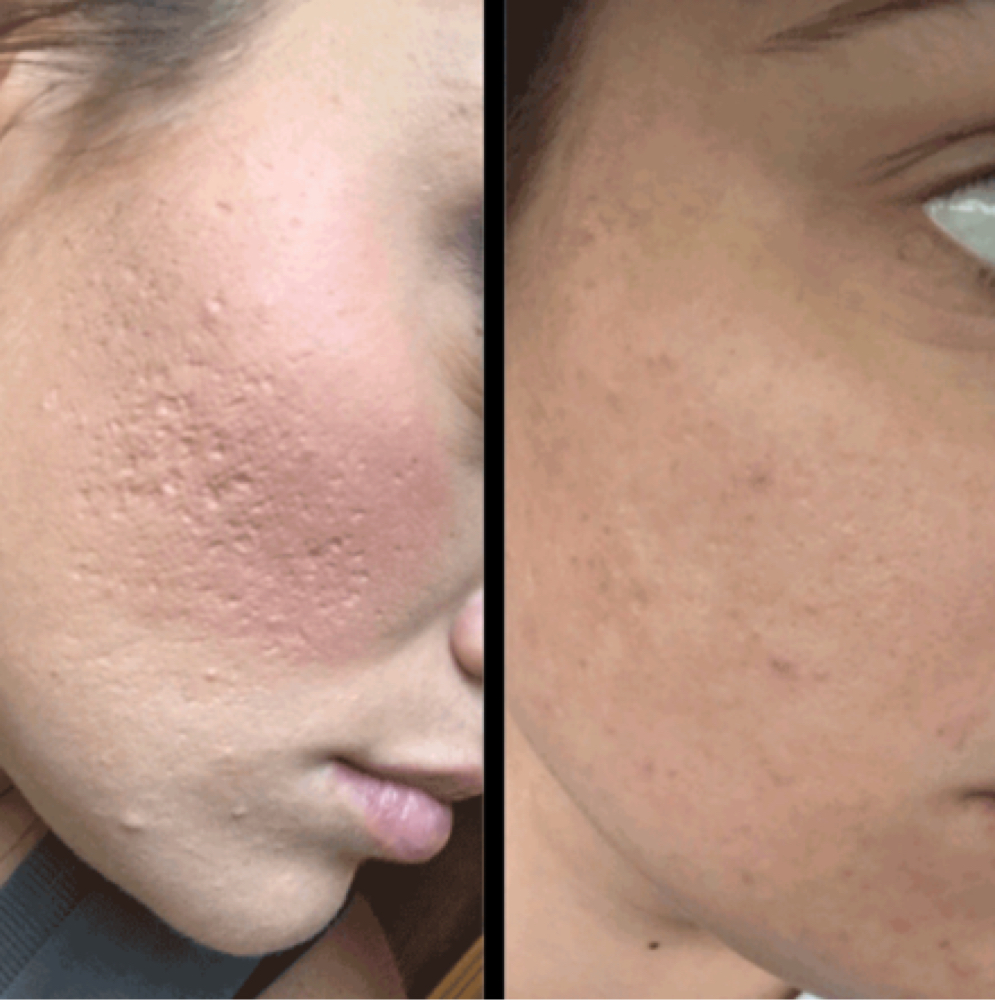 Microchanneling - Growth Factor